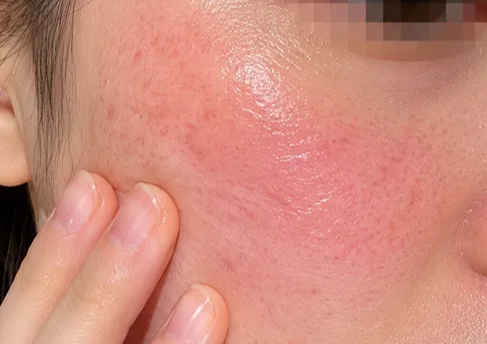 민감한 피부에 멜라토닝을 발라 붉어진 볼 모습