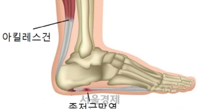 족저근막염 이미지