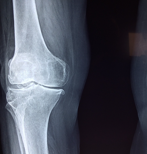 골다공증에 좋은 음식 8가지