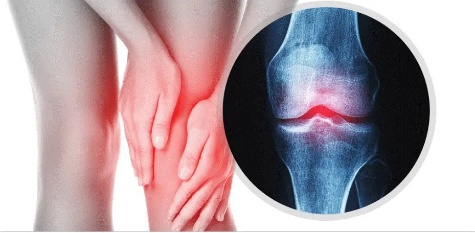 무릎 관절염 통증 , 무릎뼈 모양 이미지