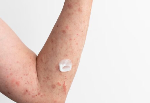 대상포진-전염-예방-수칙-전염성-1