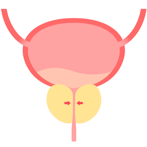 전립선비대증-요도압박