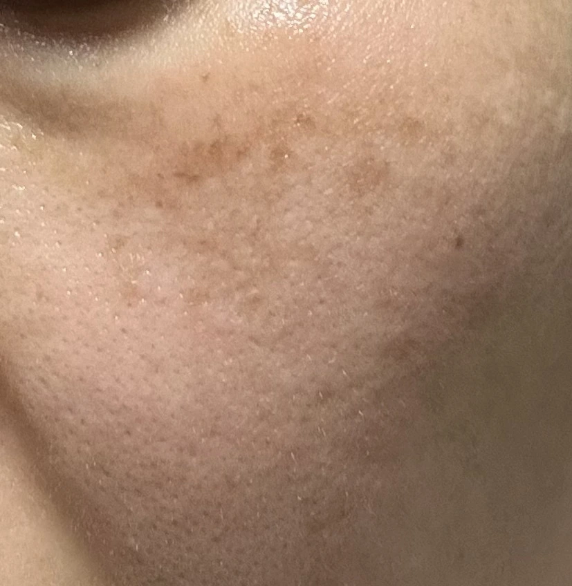 얼굴 기미 잡티 제거 멜라논 크림 2개월 사용 후기