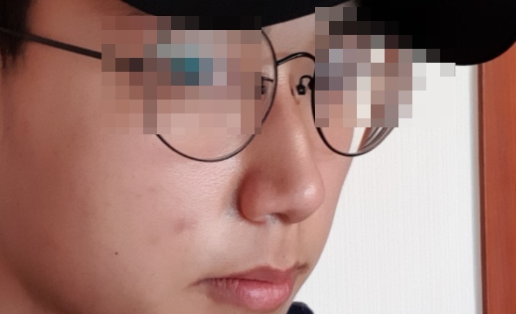 비중격 만곡증 수술 후기