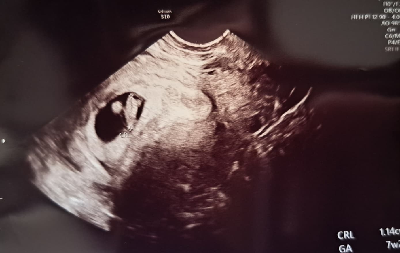 셋째 임신 증상, 난소 물혹이 임신 증상이라구요..!?