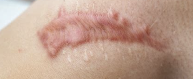 켈로이드 주사1