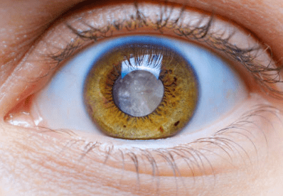 백내장 수술비용