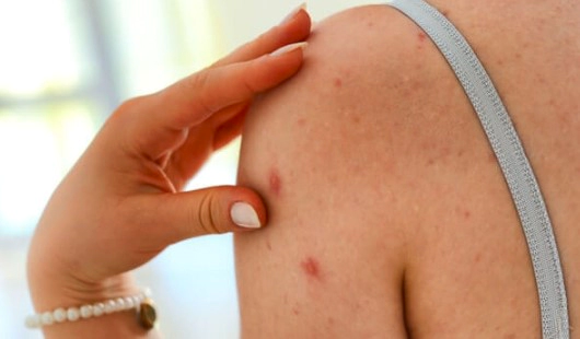 대상포진 병원 예방접종 가격 