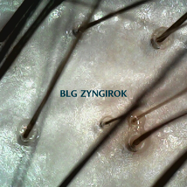 탈모 극복 프로젝트 - 정수리와 이마 사이 두피 모습이다.