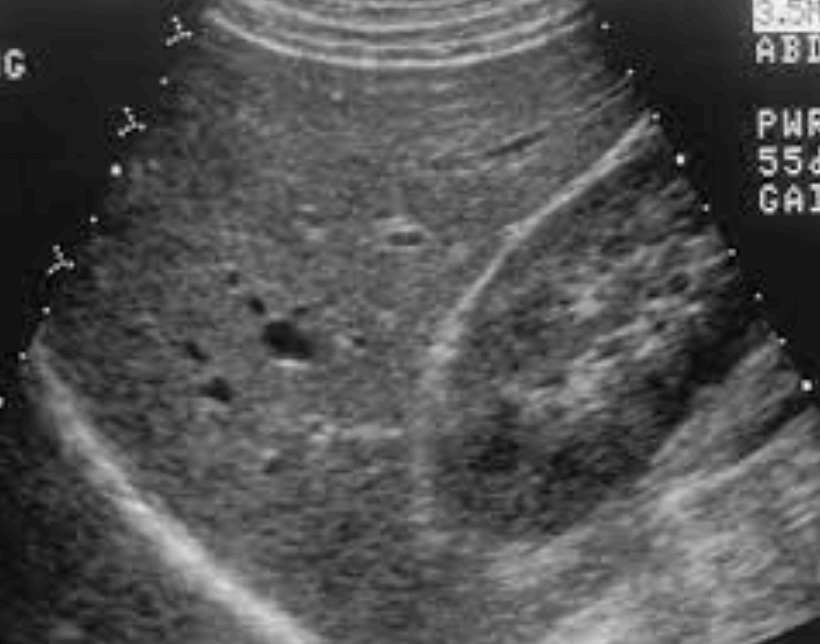 만성간염 (Chronic hepatitis)