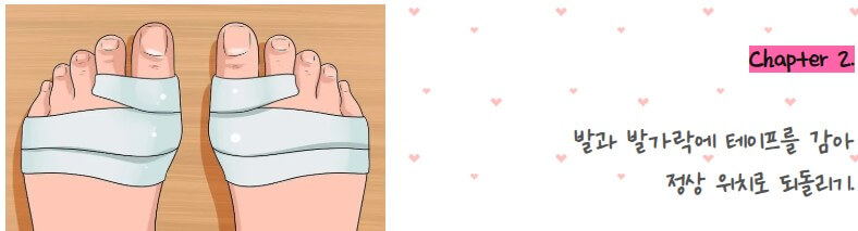 무지외반증 발가락 테이핑