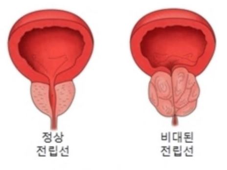 전립선-비대증