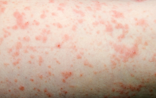 콜린성 두드러기 증상과 원인 그리고 치료법