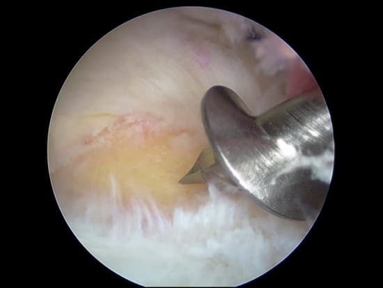 어깨 관절경 수술에 사용되는 앵커의 종류