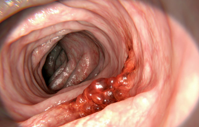 대장암 초기증상