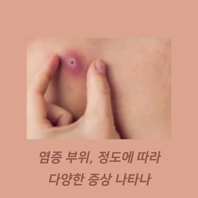 엉덩이 종기가 생기는 이유 왜 생기고 어떻게 관리할까요 완벽 가이드_6