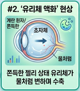 비문증 원인