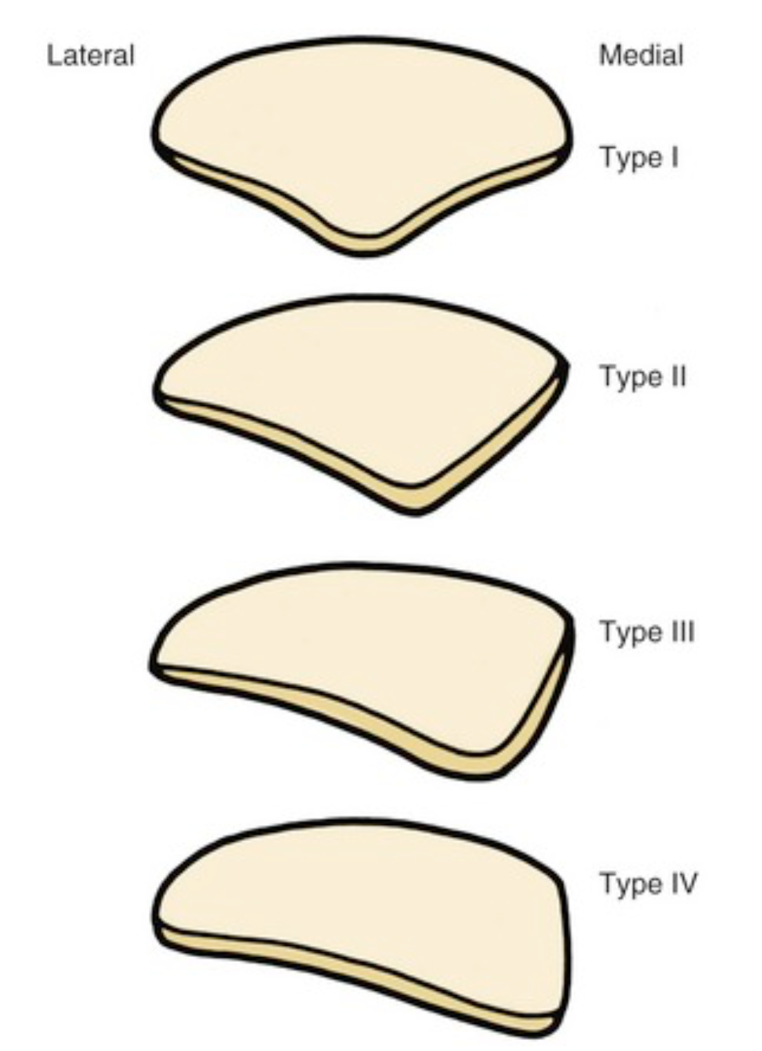 슬개골 타입별 형상