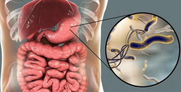 헬리코박터균 감염의 치료 