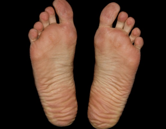 발바닥 감각이 둔하다 원인