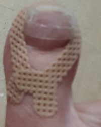 내성발톱 테이프