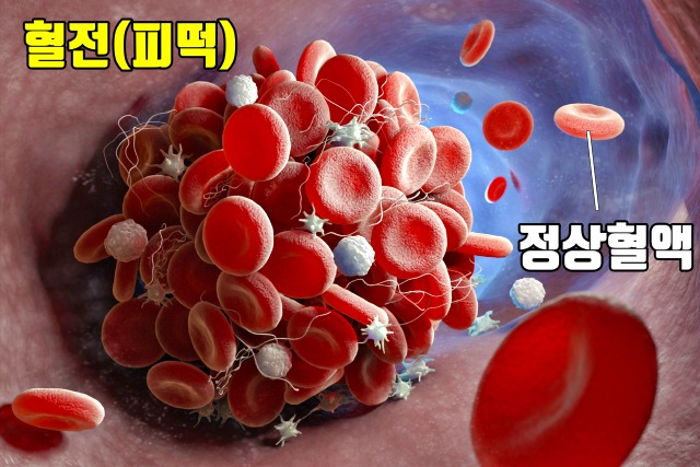 혈전에 좋은 음식,혈전 녹이는 음식,팁줌