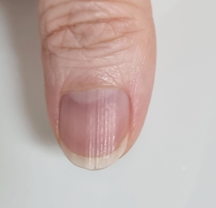 손톱에 세로로 줄이 생겨 있는 사진