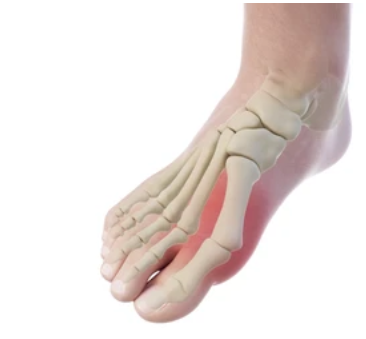 무지외반증 증상