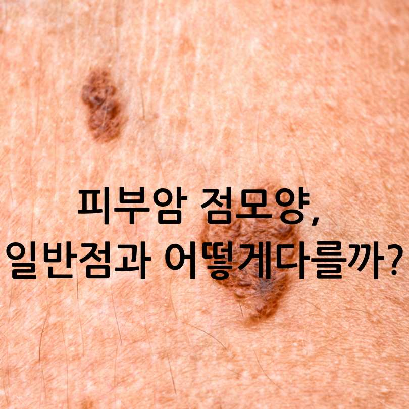 피부암 자가진단법&amp;#44; 피부암 점모양과 초기증상