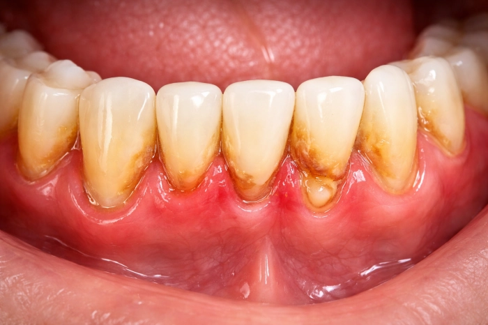 당뇨 합병증 종류