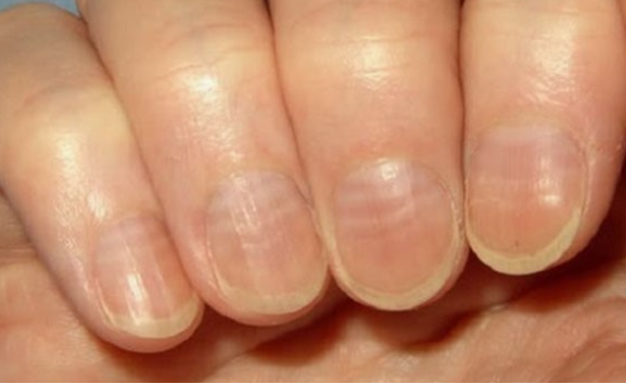 가로손톱 사진