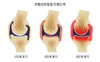 관절염에 좋은 음식 TOP 10_24
