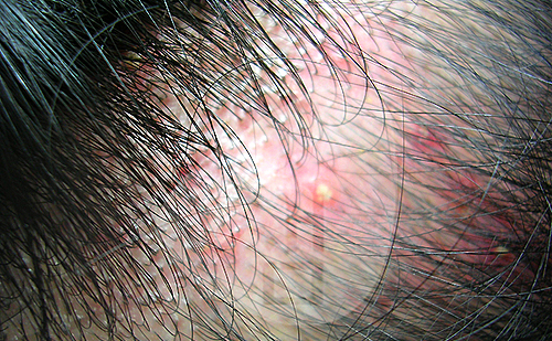 지성 두피 건성 두피 민감성 두피 탈모증상