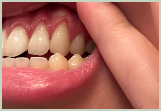 잇몸이 내려 앉은 원인