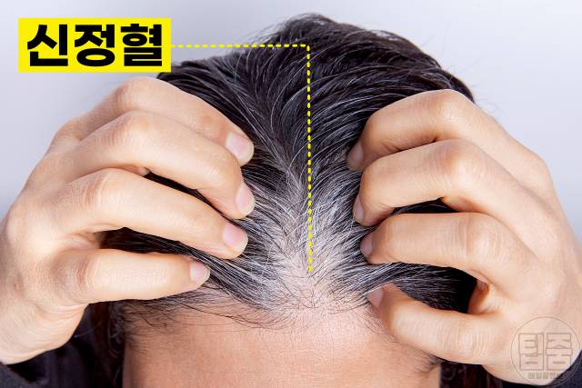 흰머리 나는 부위 뇌전증 흰머리 부위별 원인