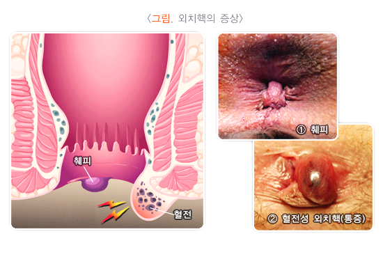 외치핵의 증상