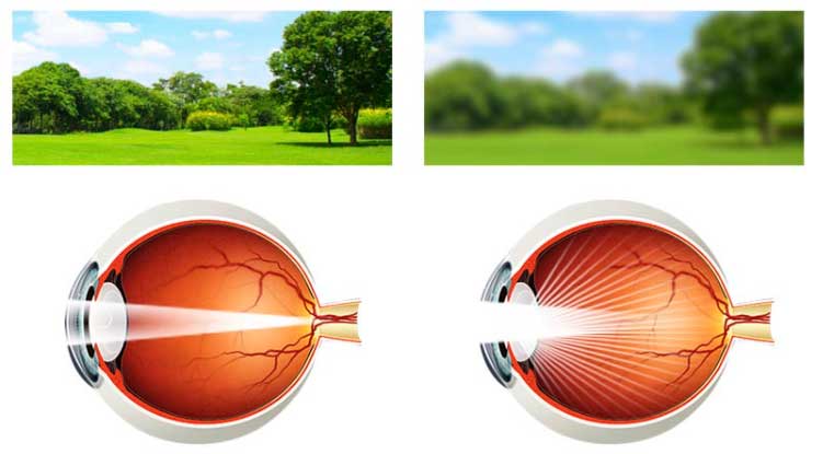 백내장 증상 시야기 희미하게 보인다