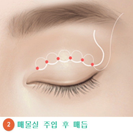 비절개 상안검 수술과정 두번째