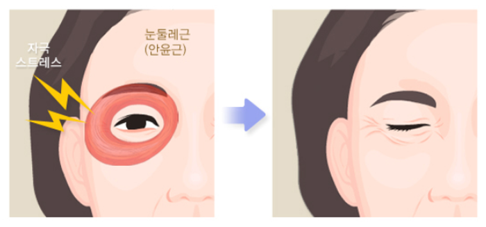 눈밑 떨림, 눈꺼풀 떨림