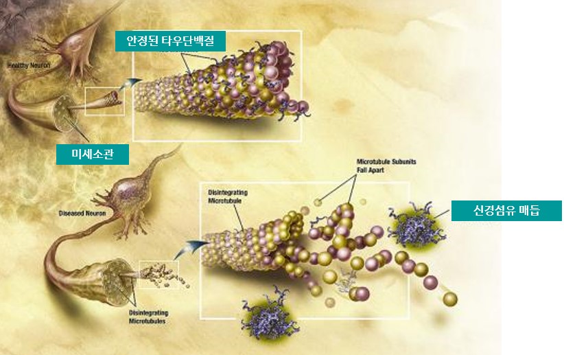 뉴런의 미세소관이 분해되는 그림 출처 Wikimedia Commons NIA NIH