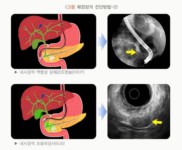 췌장 검사, 췌장암 검사방법, 아밀라아제, 비용, 병원, MRI 완전정복