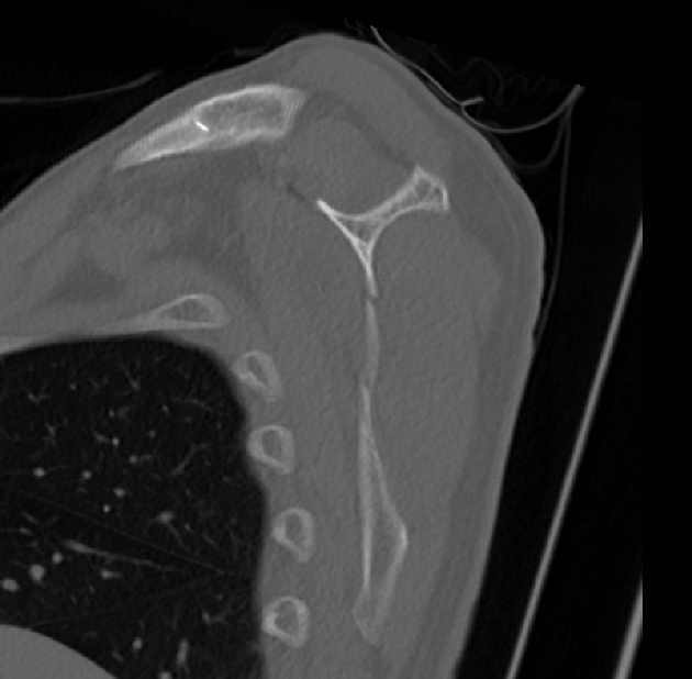 scapular sagittal image
