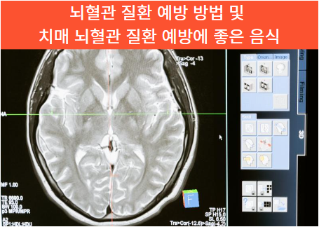 예방방법및 치매 뇌혈관 질환 예방에 좋은 음식