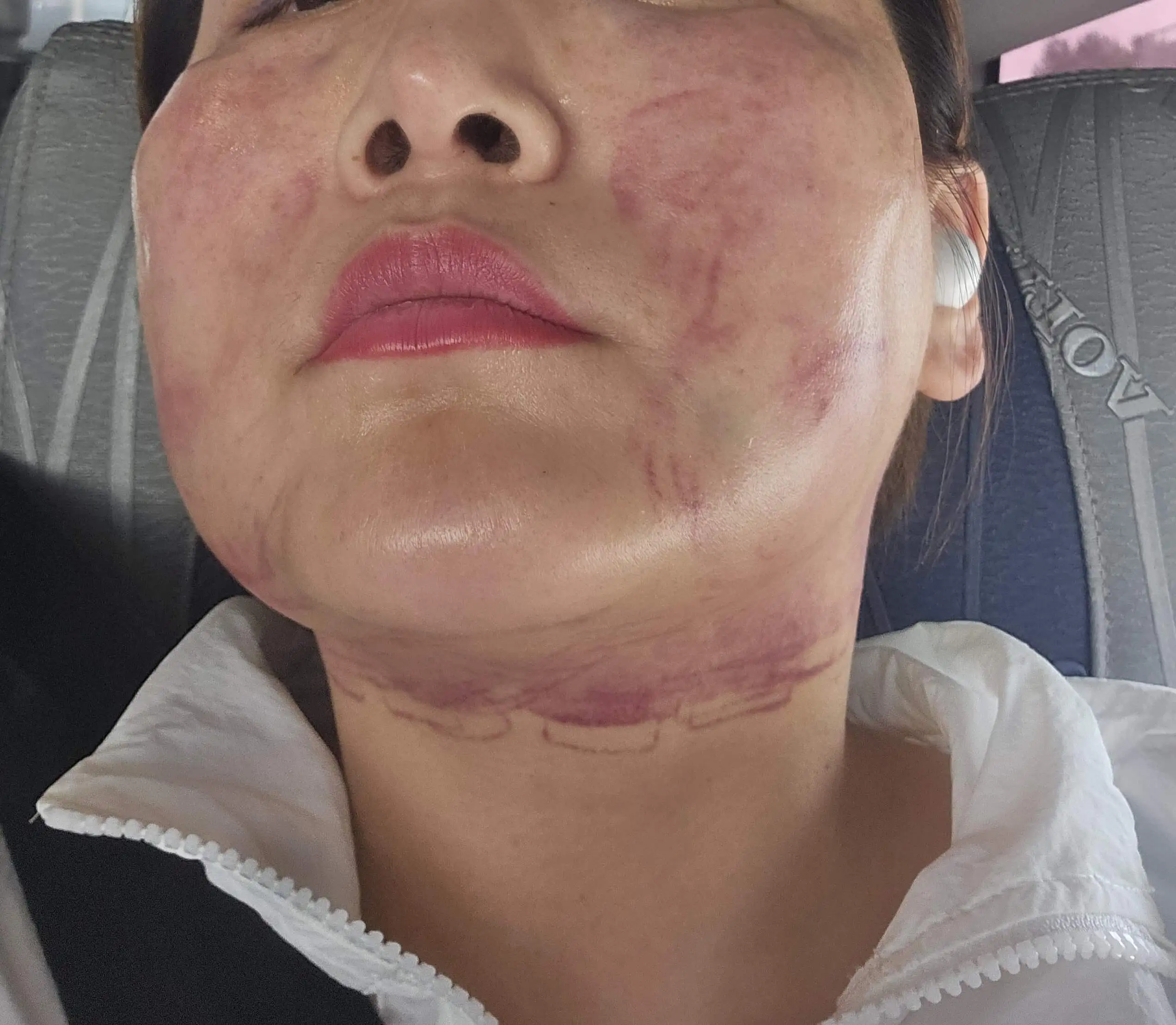 울쎄라 1200샷 + 써마지 600샷 후기 43세 첫 리프팅, 지금은 후회하는 이유