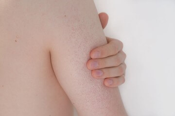 모공각화증 미스트 효과 있을까? 셀프 치료와 원인&amp;#44; 주요 증상들이 어떤 것들이 있는지 참고 하시기 바랍니다. 
