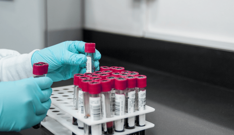 손이 저리는 이유를 알아보기 위해 혈액 검사를 진행