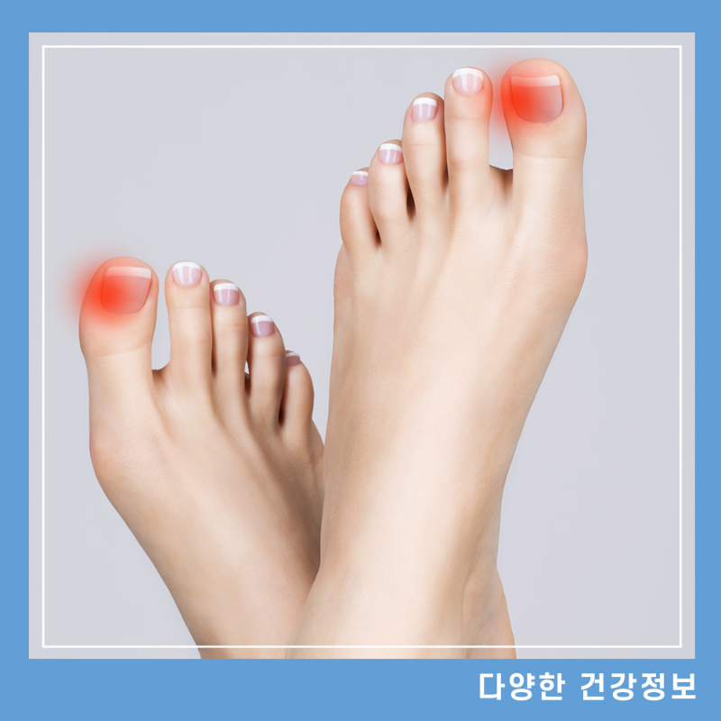 내성발톱-병원-자가치료