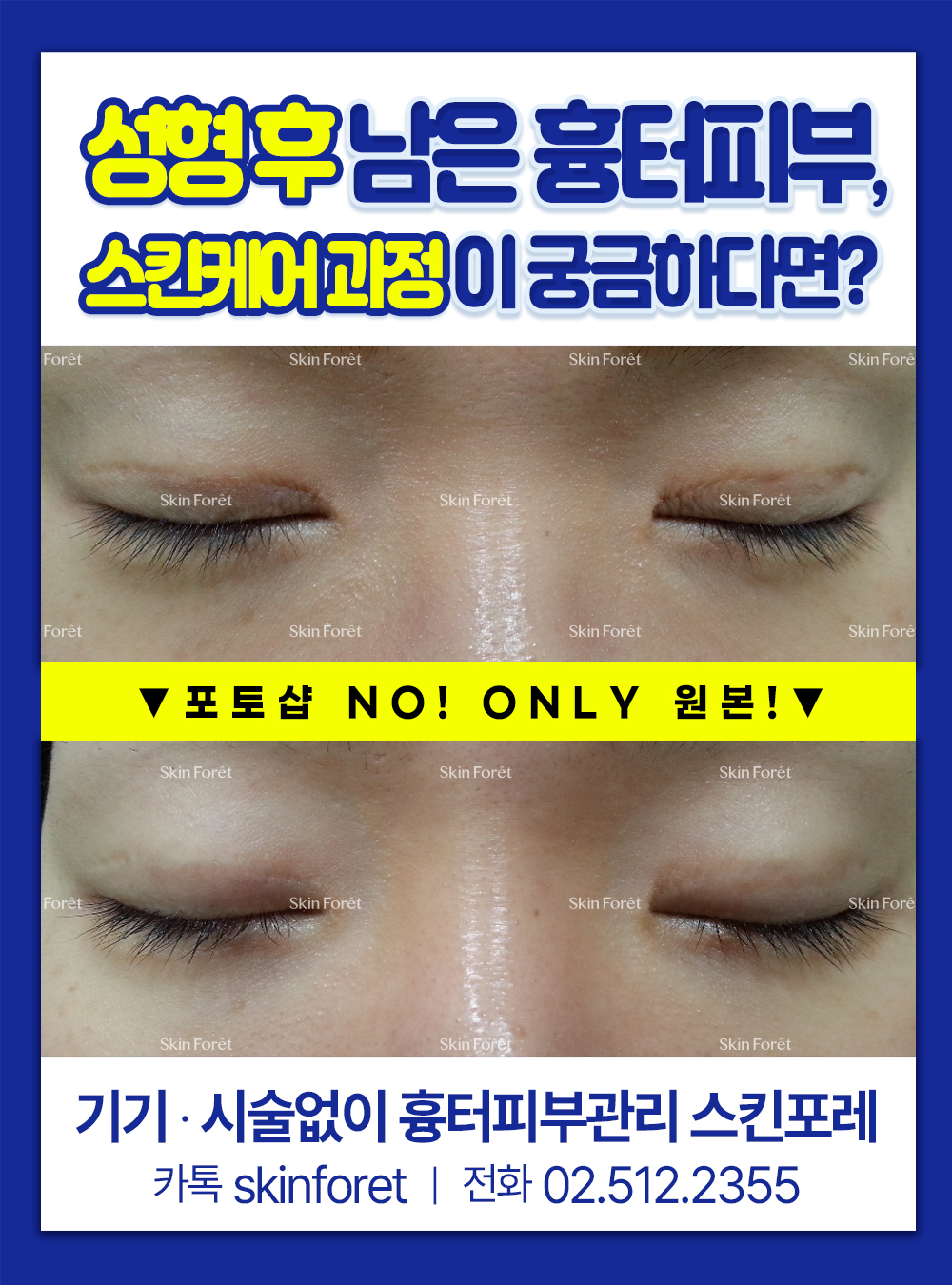 성형 후 생긴 쌍꺼풀 흉터를 스킨포레에서 케어한 전후 사진