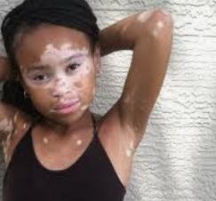 백반증 초기증상 19