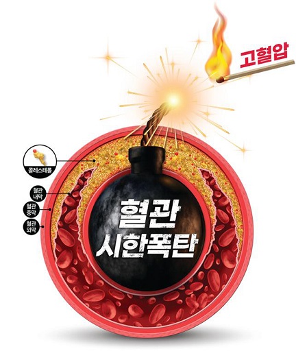 글의 이해를 돕기 위한 고협압 위험성 이미지